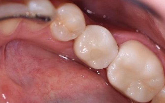 Dental Implants Case 1 - Victoria, TX - After