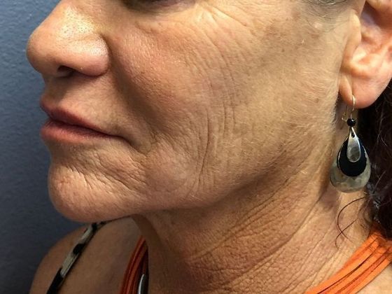 PDO Threads: Case 3 - Before