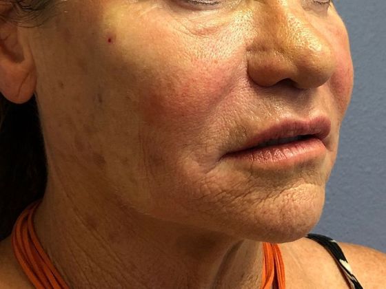 PDO Threads: Case 3 - After