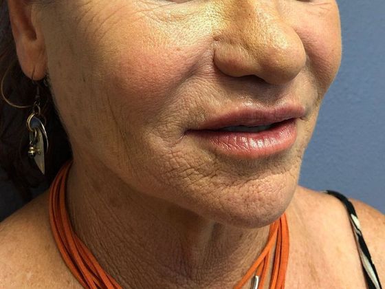 PDO Threads: Case 3 - Before