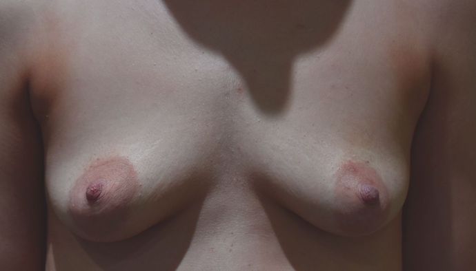 Breast Augmentation w/ Lift Case 285 - Before