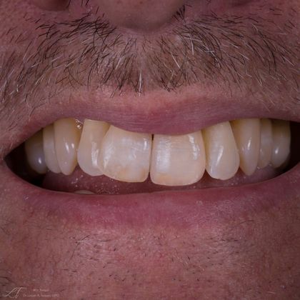 Dental Crowns: Cosmetic Upper Front Tooth - After