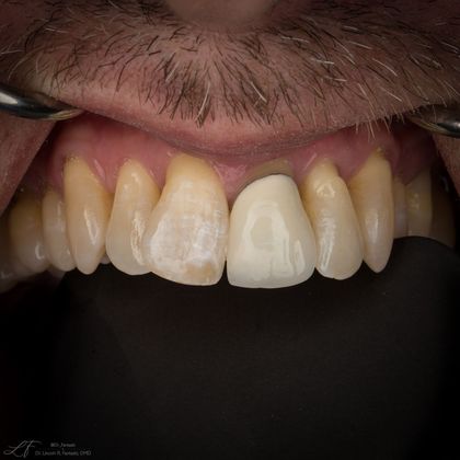 Dental Crowns: Cosmetic Upper Front Tooth - Before