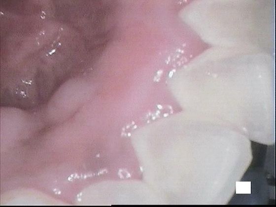 Teeth Cleaning Case 3 Excellent Teeth Cleaning - Before