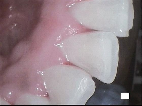 Teeth Cleaning Case 3 Excellent Teeth Cleaning - After