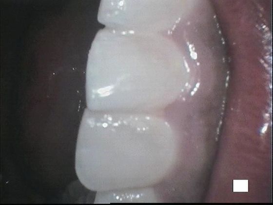 Teeth Cleaning: Case 4 Dental Cleaning - Before