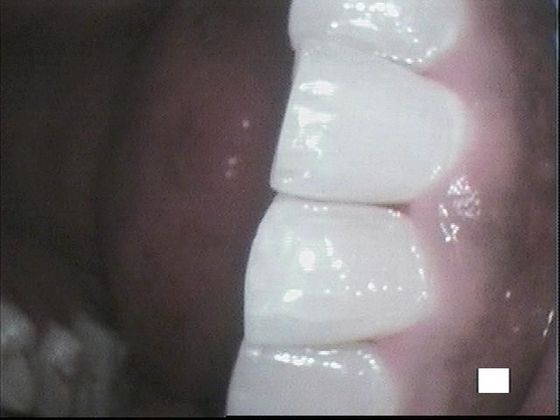 Teeth Cleaning: Case 4 Dental Cleaning - After