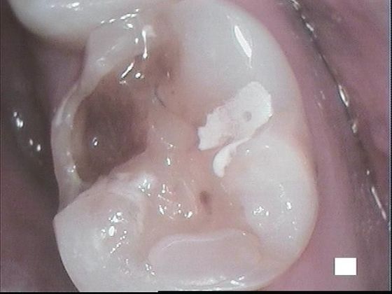 White Fillings: Case 9 Severely Decayed Molar - Before