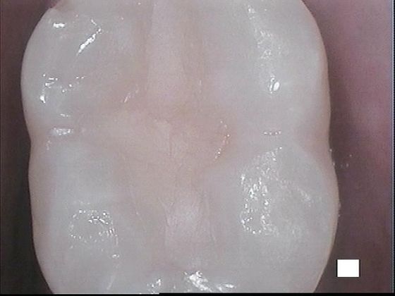 White Fillings: Case 9 Severely Decayed Molar - After