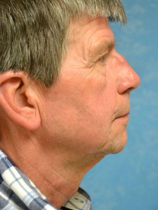 Face & Neck Lifts: Case 1501 - Hudson, MI - Before
