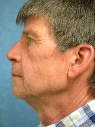 Face & Neck Lifts Case 1501 - Hudson, MI - Before