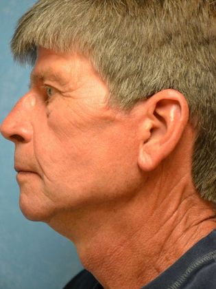 Face & Neck Lifts Case 1501 - Hudson, MI - After