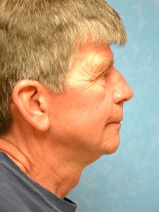 Face & Neck Lifts: Case 1501 - Hudson, MI - After