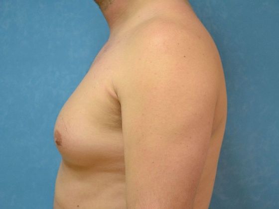 Gynecomastia: Case 1506- Toledo, OH - Before