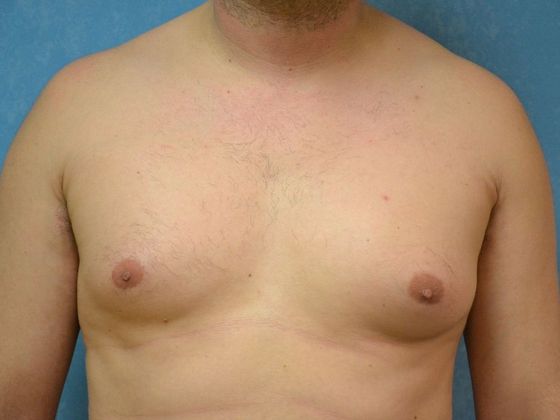Gynecomastia: Case 1506- Toledo, OH - Before