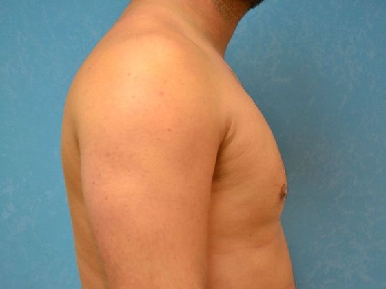 Gynecomastia: Case 1506- Toledo, OH - After