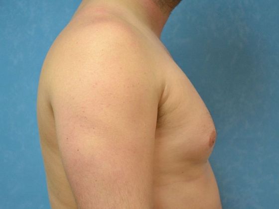 Gynecomastia: Case 1506- Toledo, OH - Before