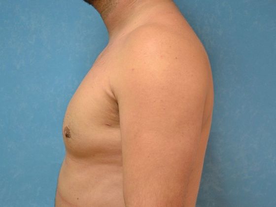Gynecomastia: Case 1506- Toledo, OH - After