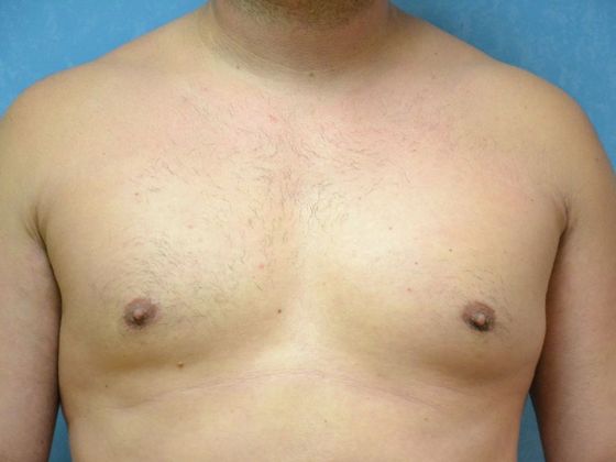 Gynecomastia: Case 1506- Toledo, OH - After