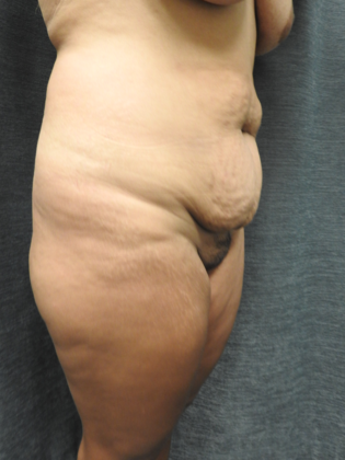 Abdominoplasty Case 18 - San Antonio - Before