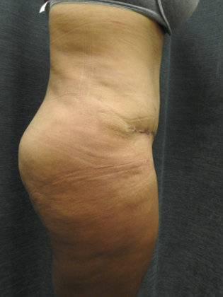 Abdominoplasty Case 18 - San Antonio - After