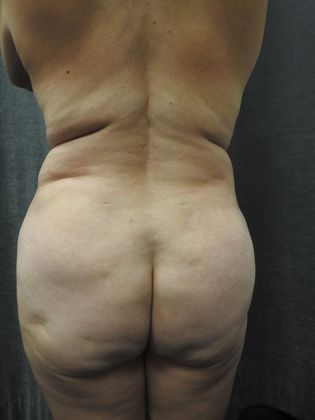 Laser Liposuction Case 7 - San Antonio - Before