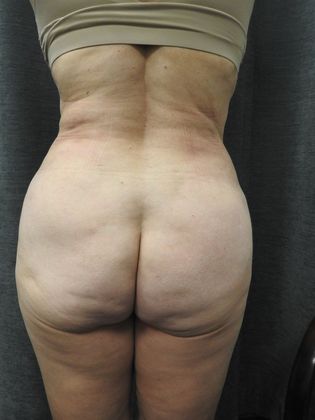 Laser Liposuction Case 7 - San Antonio - After