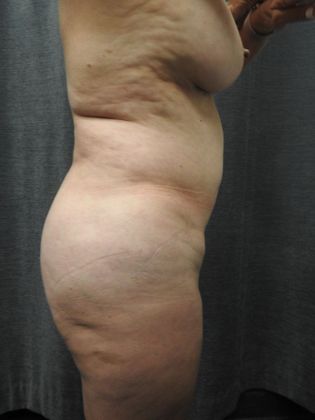 Laser Liposuction: Case 7 - San Antonio - Before