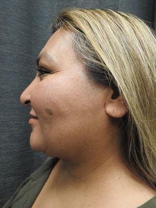 Laser Liposuction Case 8 - San Antonio - After