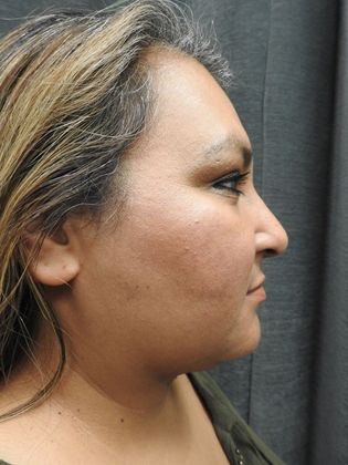 Laser Liposuction: Case 8 - San Antonio - After