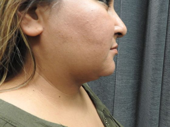 Laser Liposuction: Case 8 - San Antonio - After