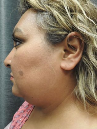 Laser Liposuction Case 8 - San Antonio - Before