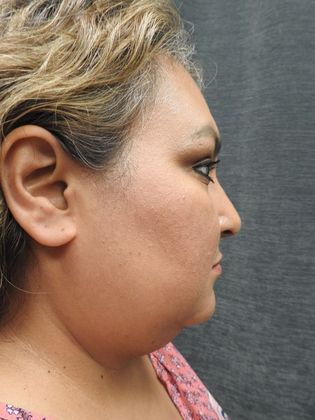 Laser Liposuction: Case 8 - San Antonio - Before