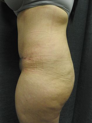 Abdominoplasty Case 20 - San Antonio - After