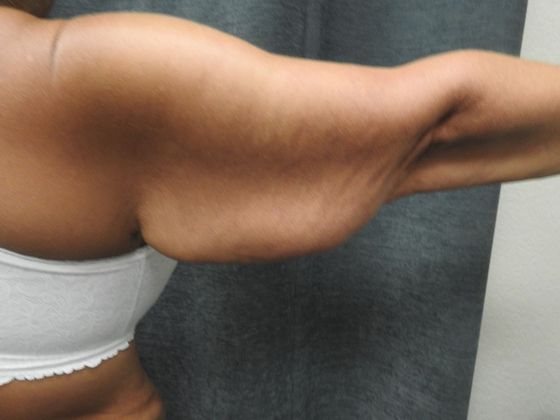 Arm Lift: Case 5 - San Antonio - Before