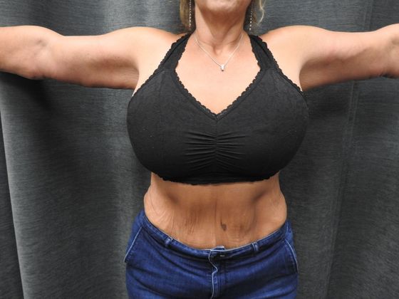 Arm Lift: Case 5 - San Antonio - After