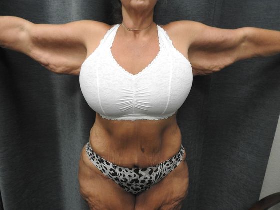 Arm Lift: Case 5 - San Antonio - Before