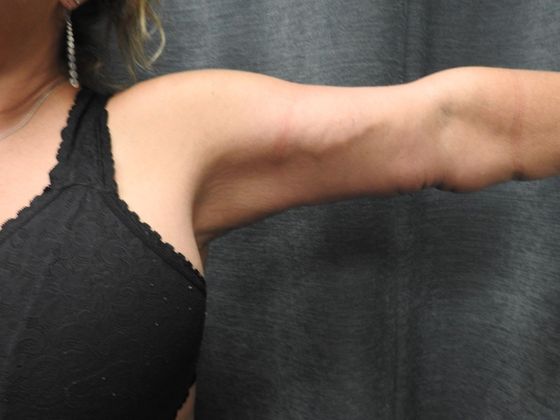 Arm Lift: Case 5 - San Antonio - After