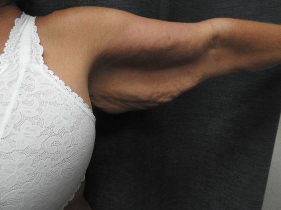 Arm Lift: Case 5 - San Antonio - Before