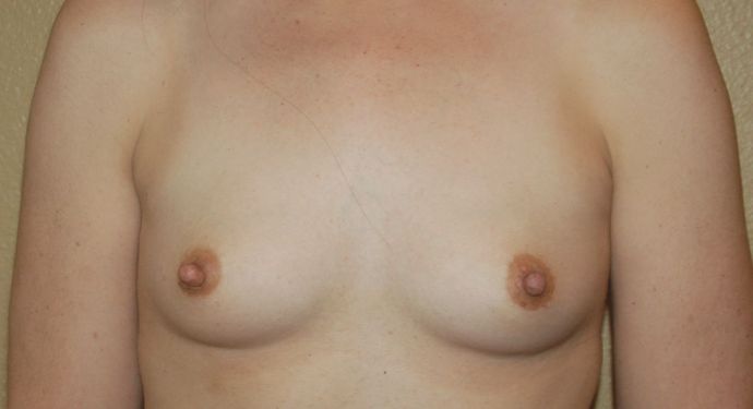 Breast Augmentation Case 570 - Before