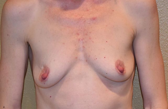 Breast Augmentation Case 571 - Before