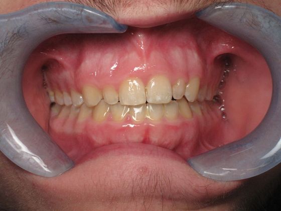 Veneers Case 1 - Before