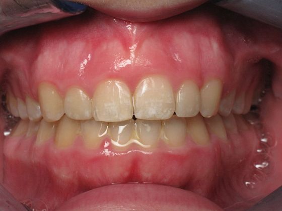 Veneers Case 1 - After