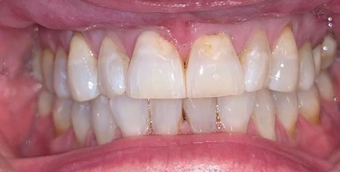 Porcelain Dental Crowns Case 2 - Before