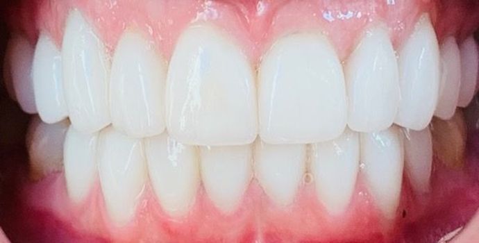 Porcelain Dental Crowns Case 2 - After