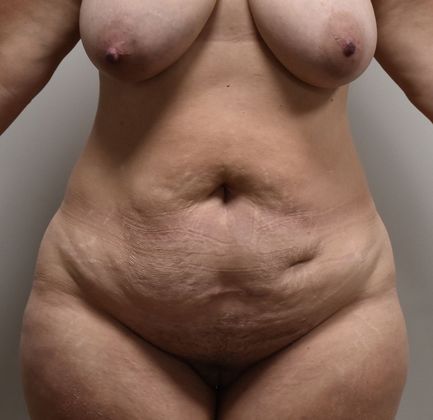 Mommy Makeover Case 140 - Before