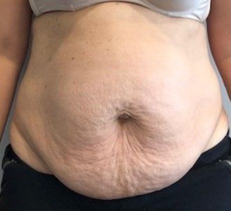 Tummy Tuck: Case 19 - Tummy Tuck with Liposuction, Norwalk, CT - Before