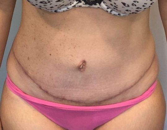 Tummy Tuck: Case 19 - Tummy Tuck with Liposuction, Norwalk, CT - After
