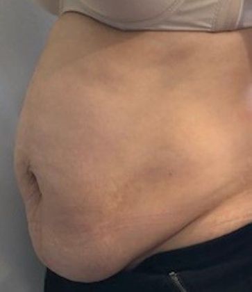 Tummy Tuck: Case 19 - Tummy Tuck with Liposuction, Norwalk, CT - Before