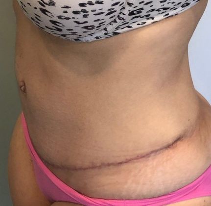 Tummy Tuck: Case 19 - Tummy Tuck with Liposuction, Norwalk, CT - After